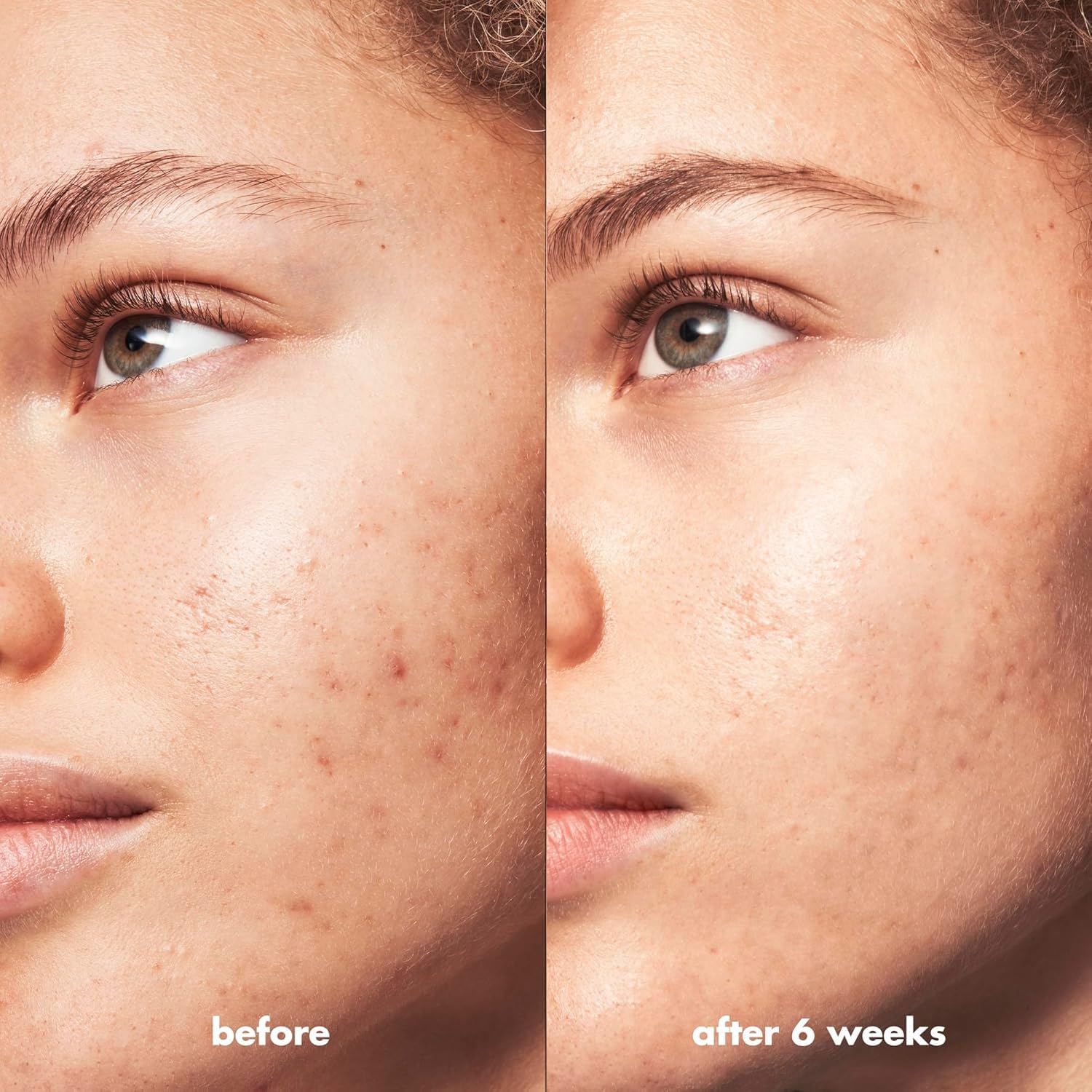 e.l.f. Skin Blemish Breakthrough Acne Calming Water Cream, Lightweight Acne - Fighting Face Moisturiser, Prevents New Blemishes & Calms Skine.l.f.609332575639Face MoisturizersFace Moisturizers