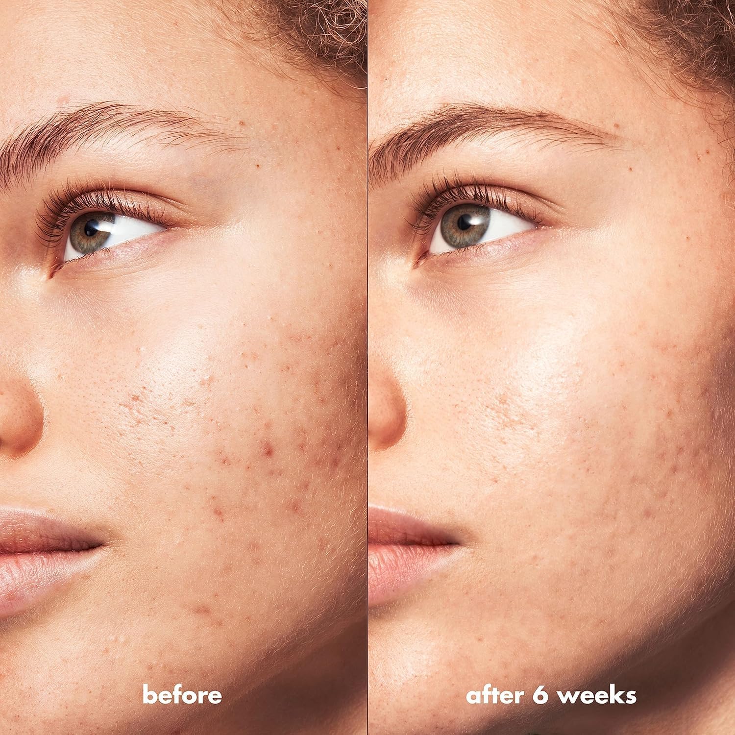 e.l.f. SKIN Blemish Breakthrough Clarifying Cleanser, Gel Cleanser For Removing Makeup, Controlling Oil & Clarifying Pores, 1% Salicylic Acid - 115mle.l.f.609332575608Gel CleanserGel Cleanser